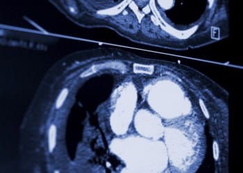 abnormal xray findings bowen 350x250 1